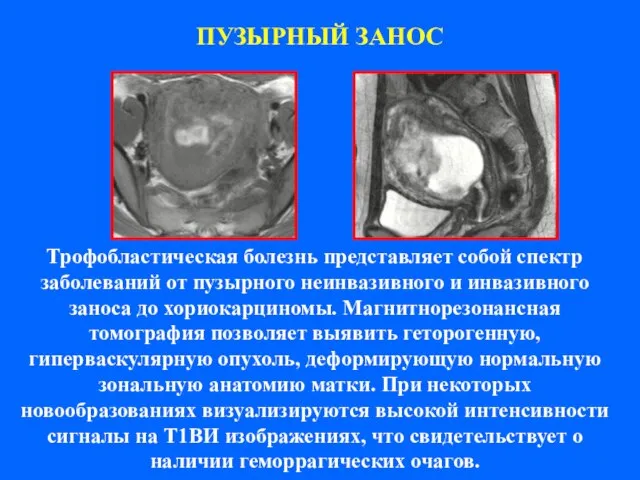 ПУЗЫРНЫЙ ЗАНОС Трофобластическая болезнь представляет собой спектр заболеваний от пузырного неинвазивного и