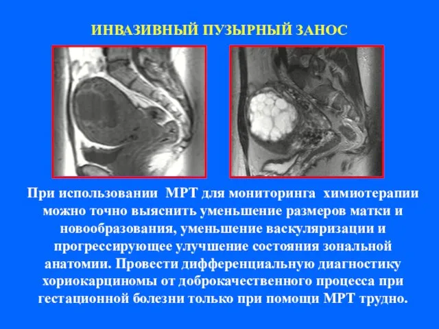 ИНВАЗИВНЫЙ ПУЗЫРНЫЙ ЗАНОС При использовании МРТ для мониторинга химиотерапии можно точно выяснить