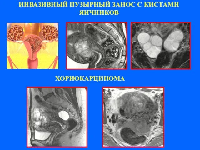 ИНВАЗИВНЫЙ ПУЗЫРНЫЙ ЗАНОС С КИСТАМИ ЯИЧНИКОВ ХОРИОКАРЦИНОМА