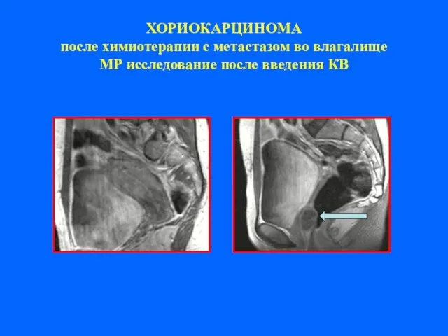 ХОРИОКАРЦИНОМА после химиотерапии с метастазом во влагалище МР исследование после введения КВ