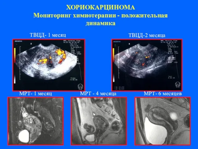 ХОРИОКАРЦИНОМА Мониторинг химиотерапии - положительная динамика TВЦД- 1 месяц TВЦД-2 месяца МРТ-