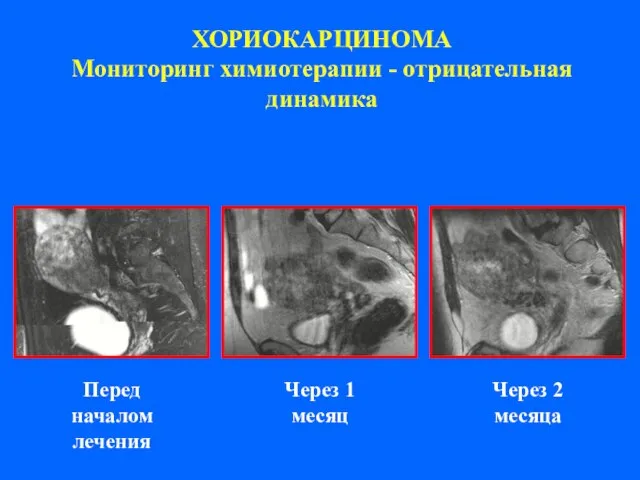 ХОРИОКАРЦИНОМА Мониторинг химиотерапии - отрицательная динамика Через 1 месяц Через 2 месяца Перед началом лечения