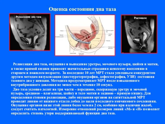 Оценка состояния дна таза Релаксация дна таза, опущение и выпадение уретры, мочевого