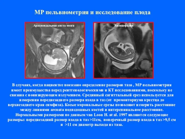 МР пельвиометрия и исследование плода В случаях, когда пациентке показано определение размеров