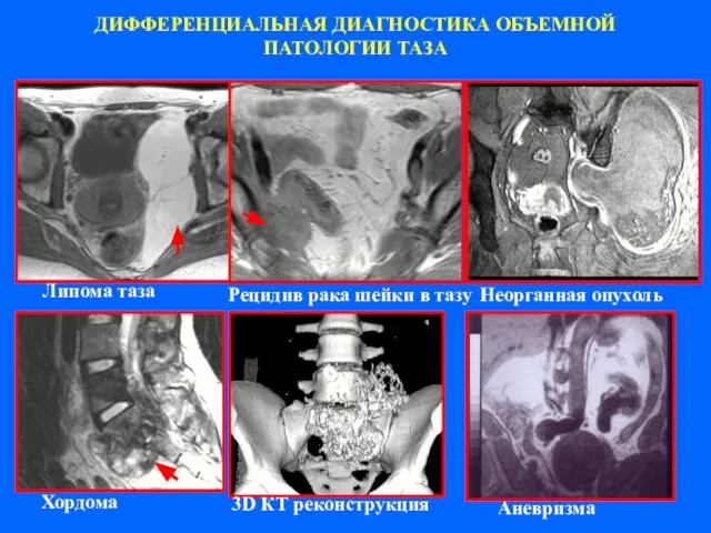 ДИФФЕРЕНЦИАЛЬНАЯ ДИАГНОСТИКА ОБЪЕМНОЙ ПАТОЛОГИИ ТАЗА Липома таза Рецидив рака шейки в тазу