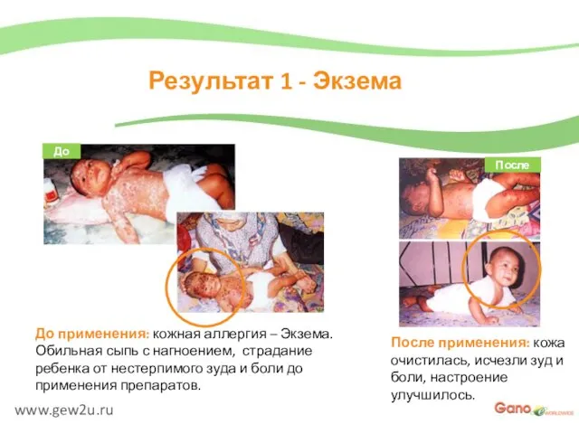 www.gew2u.ru Результат 1 - Экзема После применения: кожа очистилась, исчезли зуд и