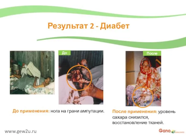 www.gew2u.ru Результат 2 - Диабет После применения: уровень сахара снизился, восстановление тканей.