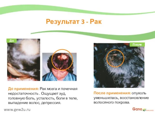 www.gew2u.ru Результат 3 - Рак После применения: опухоль уменьшилась, восстановление волосяного покрова.