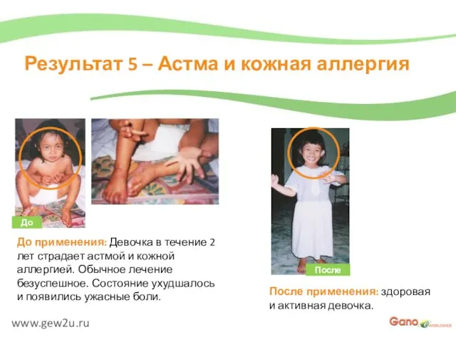 www.gew2u.ru Результат 5 – Астма и кожная аллергия После применения: здоровая и