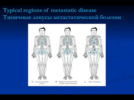 Typical regions of metastatic disease Типичные локусы метастатической болезни
