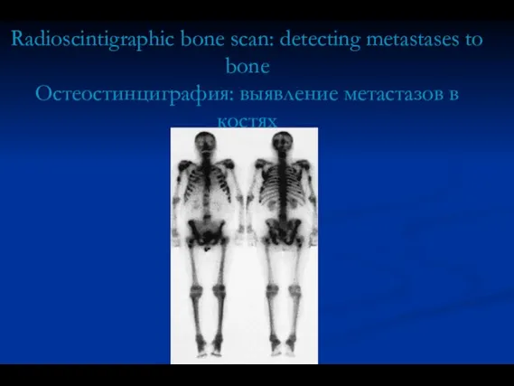 Radioscintigraphic bone scan: detecting metastases to bone Остеостинциграфия: выявление метастазов в костях