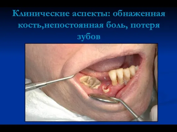 Клинические аспекты: обнаженная кость,непостоянная боль, потеря зубов