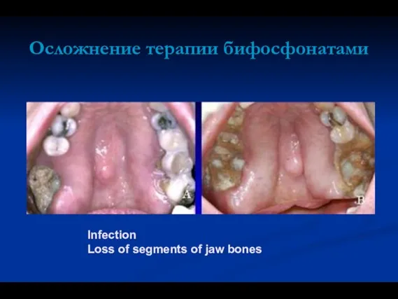 Infection Loss of segments of jaw bones Осложнение терапии бифосфонатами