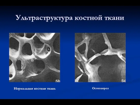 Ультраструктура костной ткани Нормальная костная ткань Остеопороз