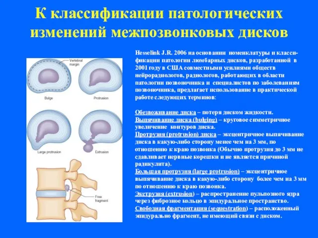 К классификации патологических изменений межпозвонковых дисков Hesselink J.R. 2006 на основании номенклатуры