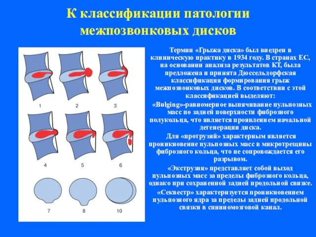 К классификации патологии межпозвонковых дисков Термин «Грыжа диска» был внедрен в клиническую