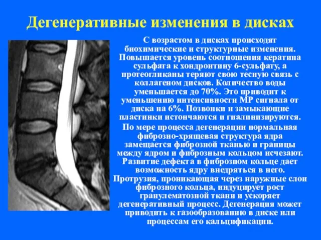 Дегенеративные изменения в дисках С возрастом в дисках происходят биохимические и структурные