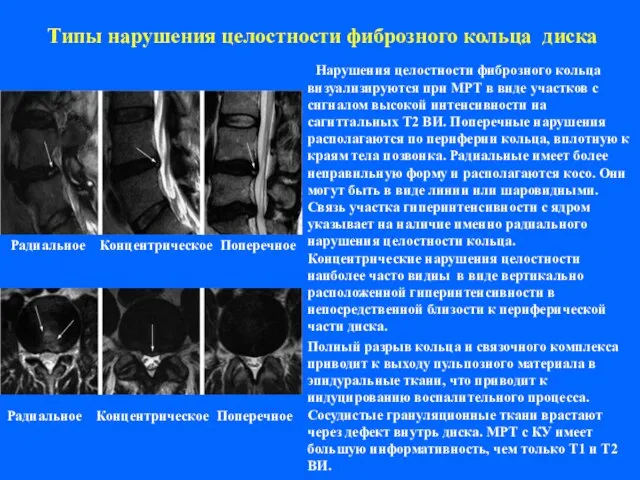 Типы нарушения целостности фиброзного кольца диска Нарушения целостности фиброзного кольца визуализируются при