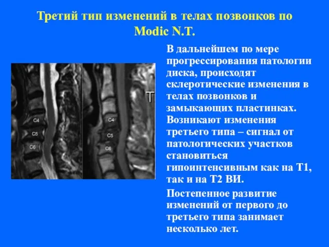 Третий тип изменений в телах позвонков по Modic N.T. В дальнейшем по