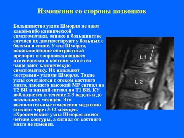 Изменения со стороны позвонков Большинство узлов Шморля не дают какой-либо клинической симптоматики,