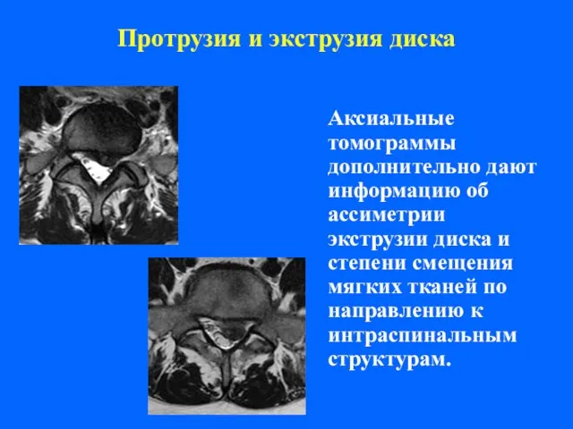 Протрузия и экструзия диска Аксиальные томограммы дополнительно дают информацию об ассиметрии экструзии