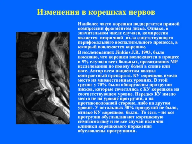 Изменения в корешках нервов Наиболее часто корешки подвергается прямой компрессии фрагментом диска.