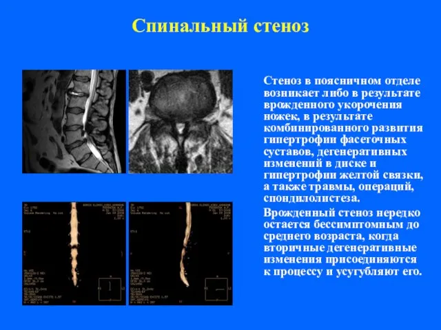 Спинальный стеноз Стеноз в поясничном отделе возникает либо в результате врожденного укорочения