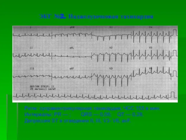 ЭКГ №2. Наджелудочковая тахикардия Ритм: суправентрикулярная тахикардия. ЧСС 155 в мин. Интервалы: