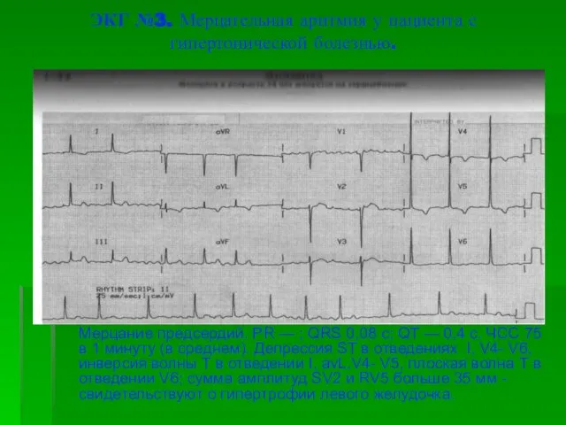ЭКГ №3. Мерцательная аритмия у пациента с гипертонической болезнью. Мерцание предсердий. PR