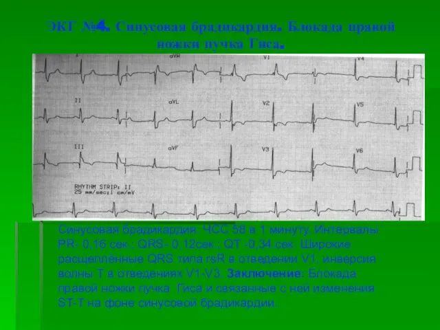 ЭКГ №4. Синусовая брадикардия. Блокада правой ножки пучка Гиса. Синусовая брадикардия. ЧСС
