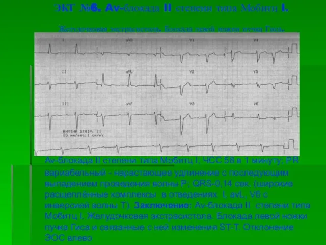 ЭКГ №6. Av-блокада II степени типа Мобитц I. Желудочковая экстрасистола. Блокада левой