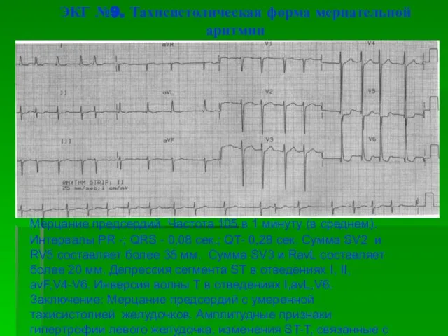 ЭКГ №9. Тахисистолическая форма мерцательной аритмии Мерцание предсердий. Частота 105 в 1