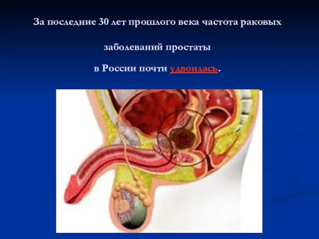 За последние 30 лет прошлого века частота раковых заболеваний простаты в России почти удвоилась.