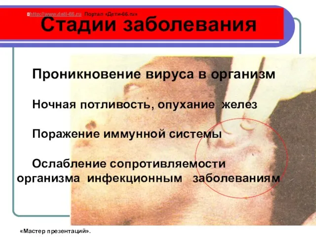 Стадии заболевания Проникновение вируса в организм Ночная потливость, опухание желез Поражение иммунной