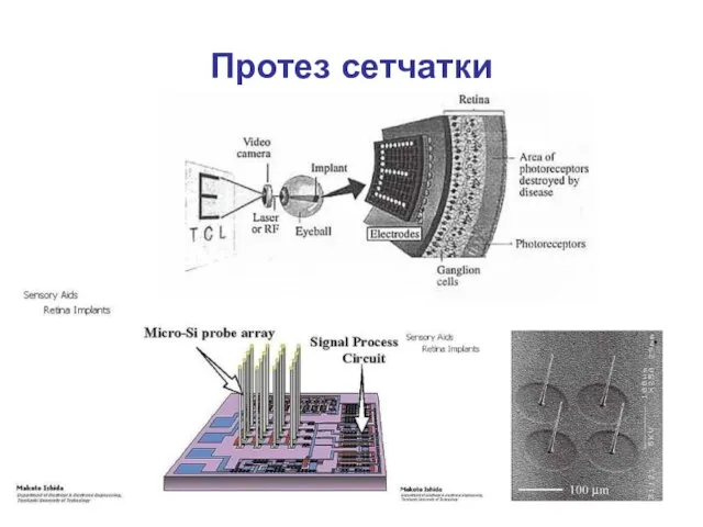 Протез сетчатки