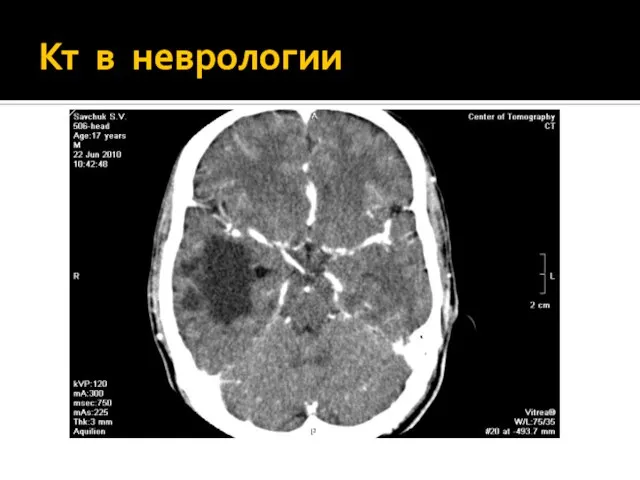 Кт в неврологии