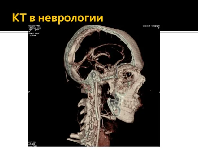 КТ в неврологии