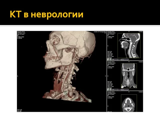 КТ в неврологии