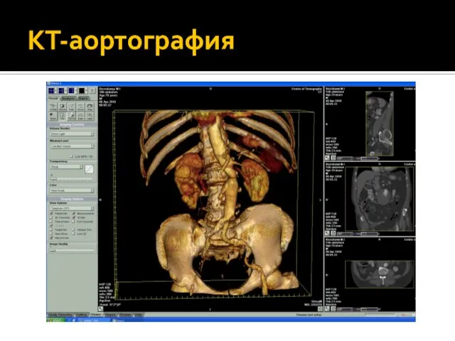 КТ-аортография