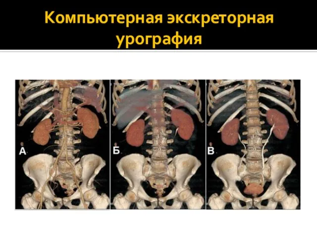 Компьютерная экскреторная урография