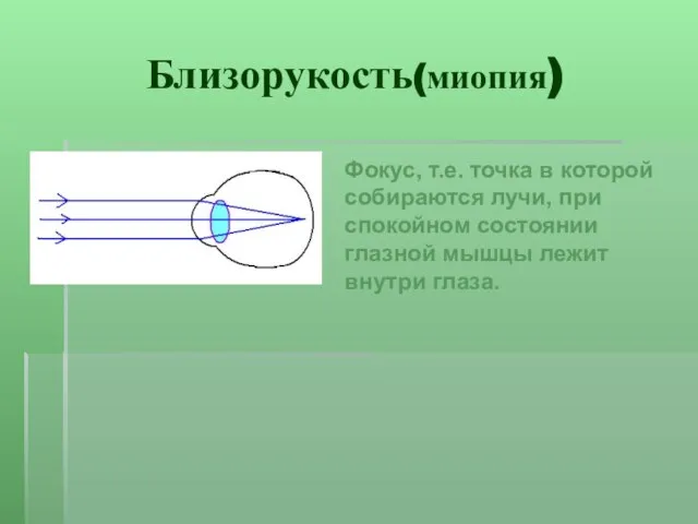 Близорукость(миопия) Фокус, т.е. точка в которой собираются лучи, при спокойном состоянии глазной мышцы лежит внутри глаза.