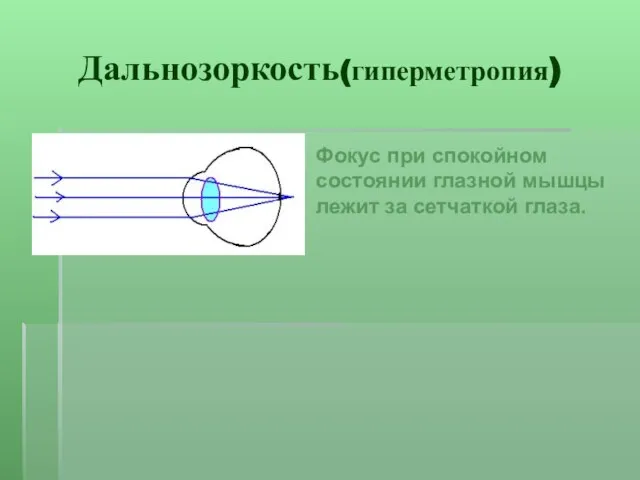 Дальнозоркость(гиперметропия) Фокус при спокойном состоянии глазной мышцы лежит за сетчаткой глаза.