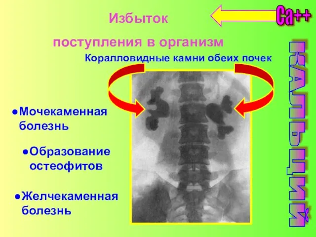 Избыток поступления в организм Ca++ Образование остеофитов Желчекаменная болезнь Мочекаменная болезнь Коралловидные камни обеих почек КАЛЬЦИЙ