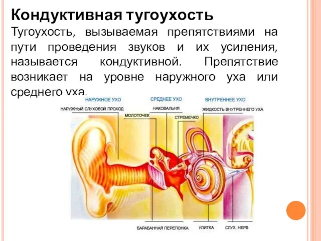 Кондуктивная тугоухость Тугоухость, вызываемая препятствиями на пути проведения звуков и их усиления,