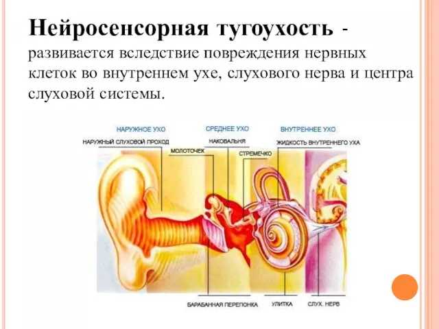 Нейросенсорная тугоухость - развивается вследствие повреждения нервных клеток во внутреннем ухе, слухового