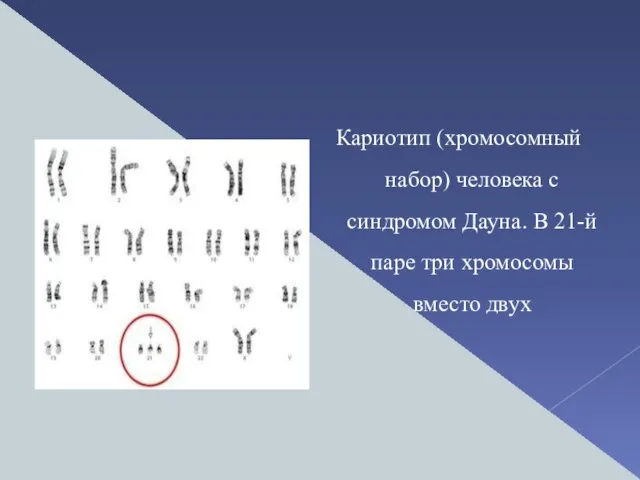 Кариотип (хромосомный набор) человека с синдромом Дауна. В 21-й паре три хромосомы вместо двух