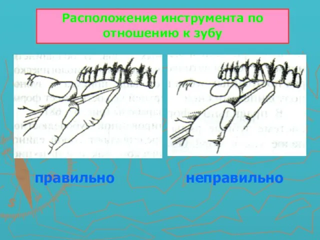 Расположение инструмента по отношению к зубу правильно неправильно