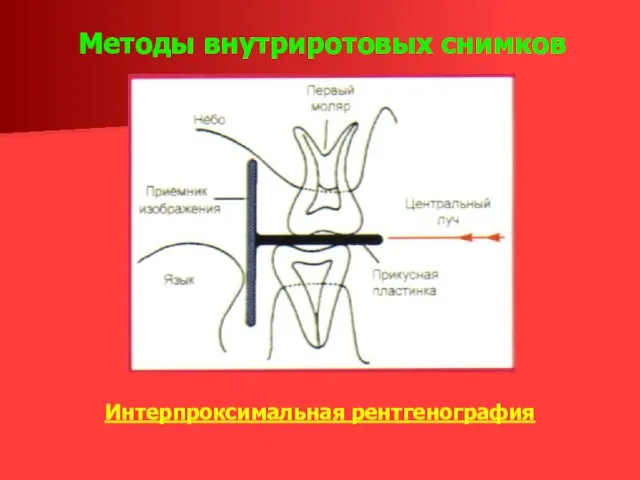 Методы внутриротовых снимков Интерпроксимальная рентгенография