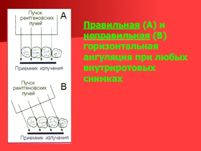 Правильная (А) и неправильная (В) горизонтальная ангуляция при любых внутриротовых снимках