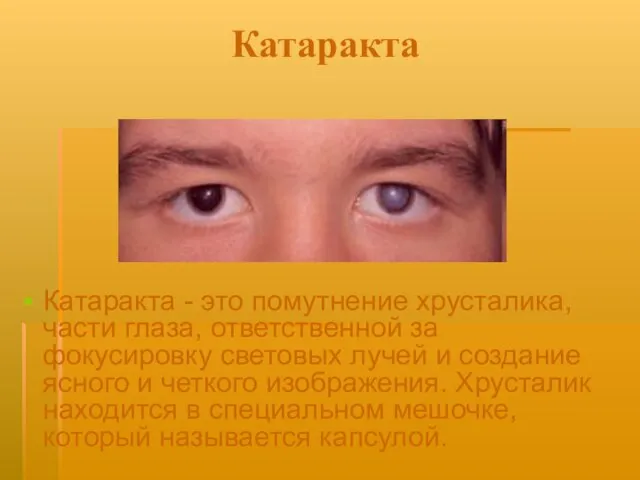 Катаракта Катаракта - это помутнение хрусталика, части глаза, ответственной за фокусировку световых